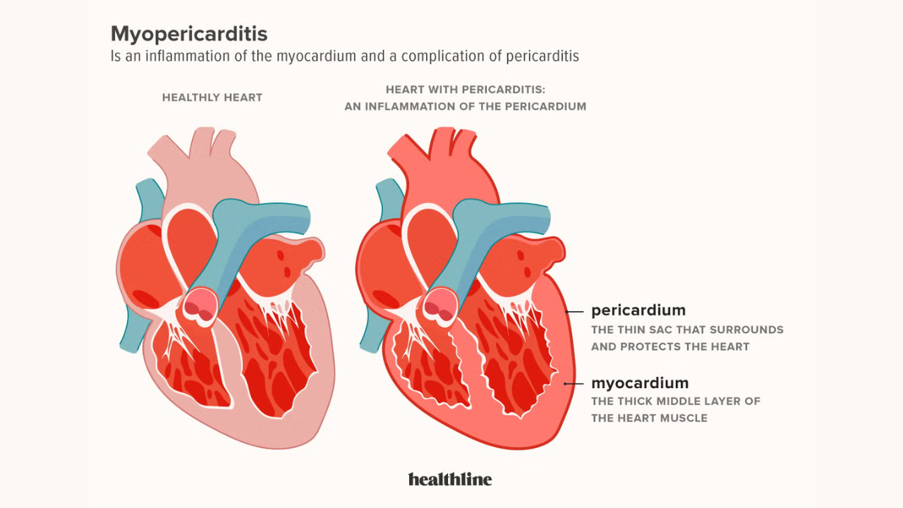 What Is Myocarditis and Pericarditis Image.png